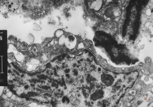 M,66y. | follicular cyst with hyaline Rushton bodies